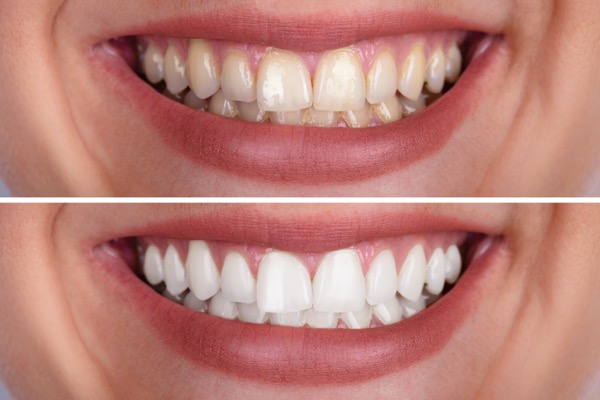 Clareamento dental