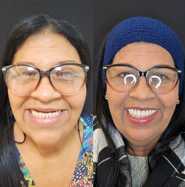 Antes e depois de implante dentário na OdontoLight