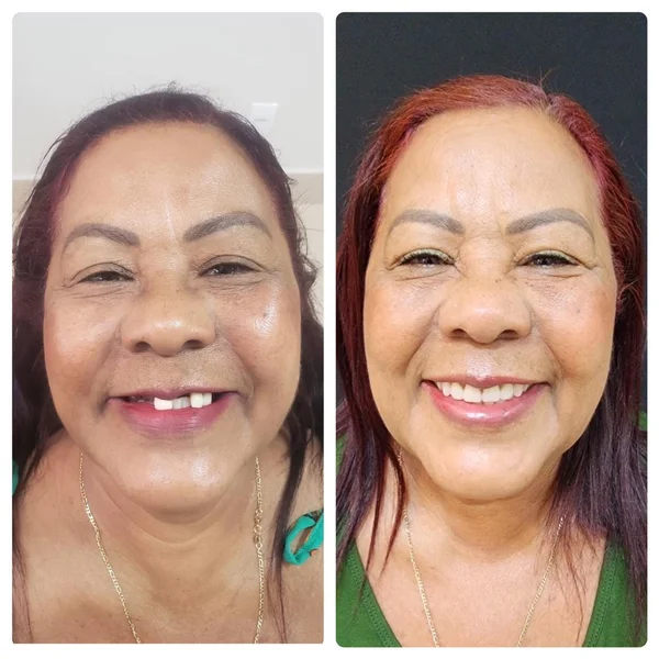 Antes e depois de implante dentário na OdontoLight