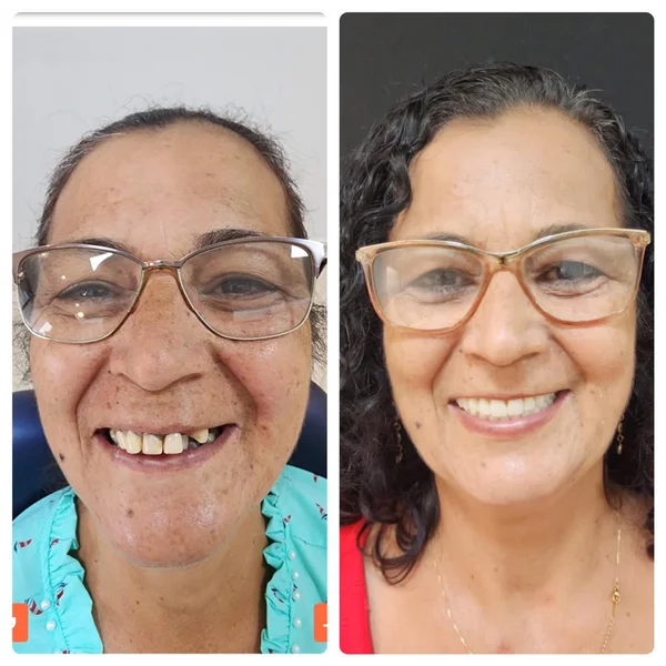 Antes e depois de implante dentário na OdontoLight