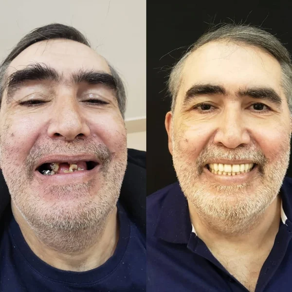 Antes e depois de implante dentário na OdontoLight