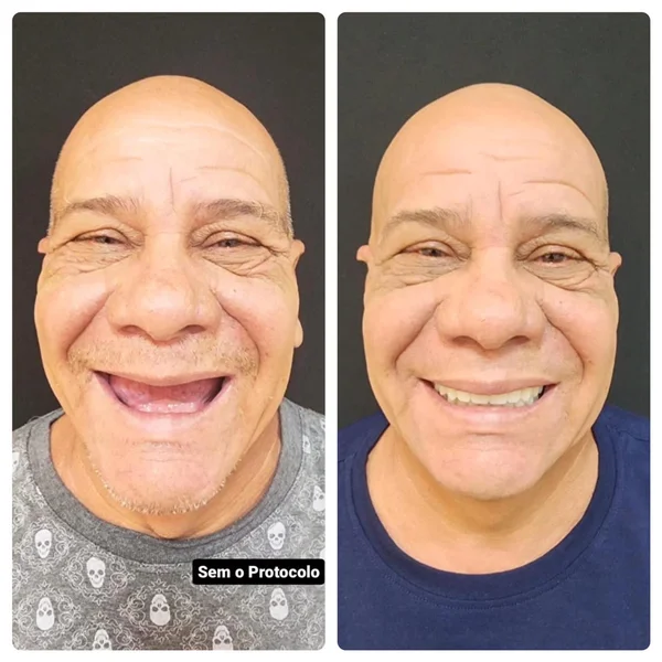 Antes e depois de implante dentário na OdontoLight