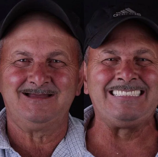 Seu Antônio, antes e depois do implante dentário na OdontoLight