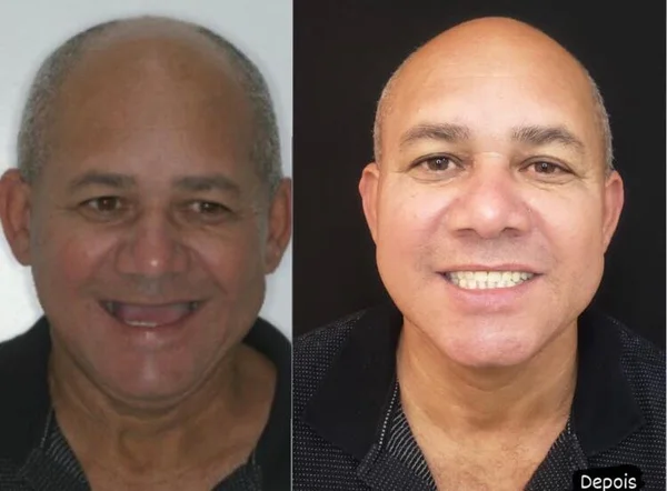Seu Roberto, antes e depois do implante dentário na OdontoLight