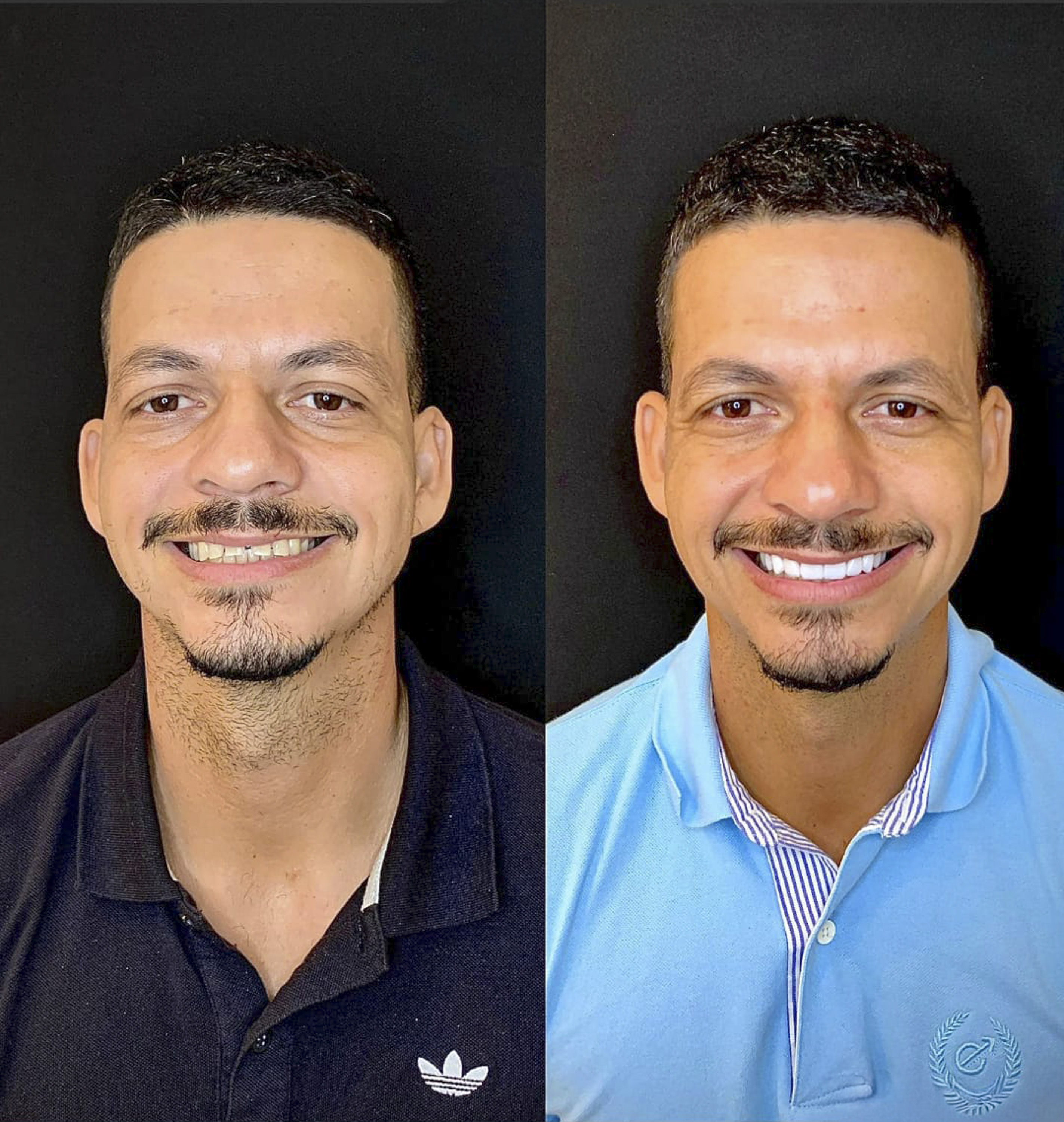 Marcos, antes e depois das lentes de contato dental na OdontoLight