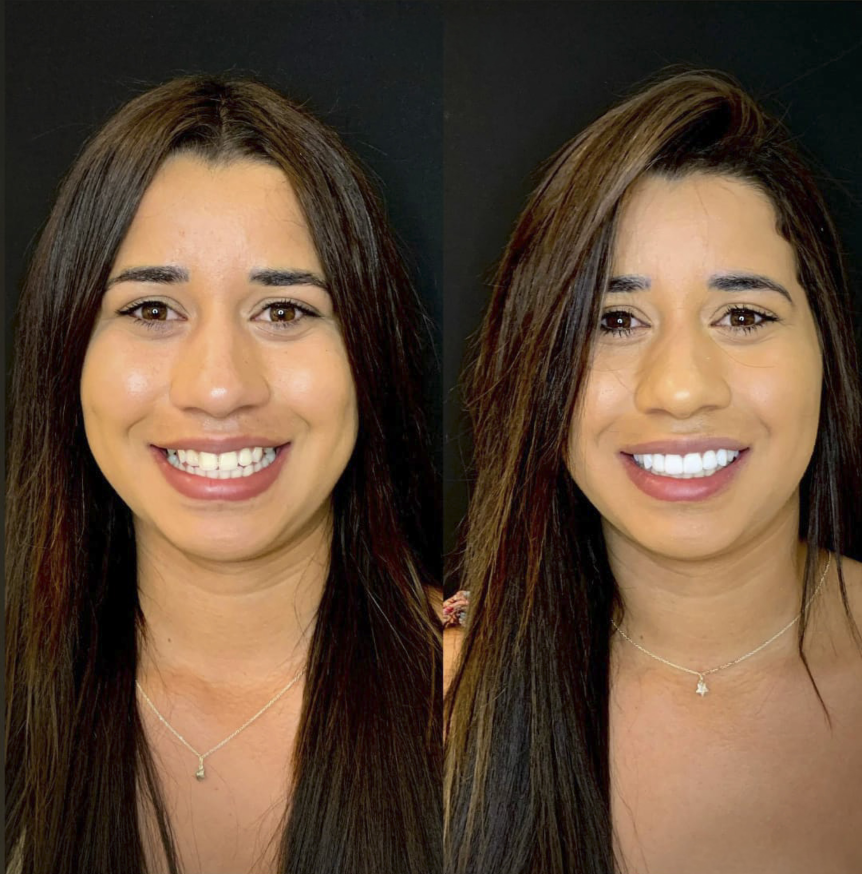 Antes e depois de lentes de contato dental na OdontoLight