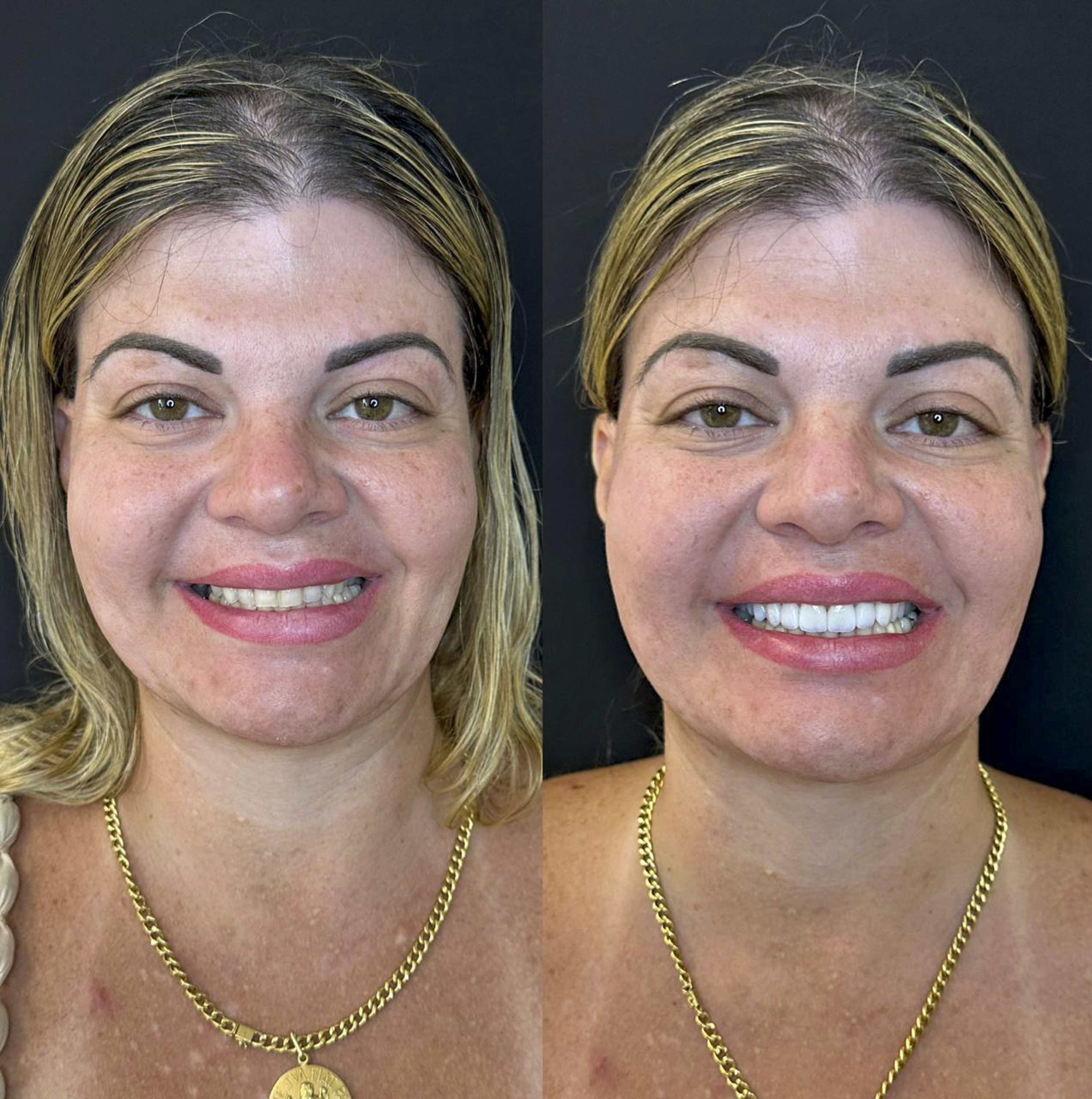 Sandra, antes e depois das lentes de contato dental na OdontoLight